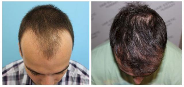 hajbeültetés hairhungary klinika hajbeültetés műtét harsányi gergely