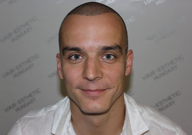 Harsányi Gergely hajbeültetése