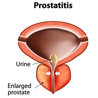 A prostatitisben működő műveletek típusai Só kötszerek a prosztatitis kezelésében